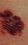 Image result for What Does Melanoma Skin Cancer Look Like