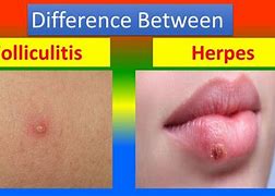 Image result for Folliculitis Axilla