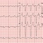 Image result for Bundle Branch Block EKG Examples