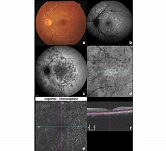 Image result for White Spots On Retina