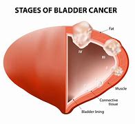 Image result for 2 Cm Bladder Tumor