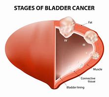 Image result for Malignant Bladder Tumor