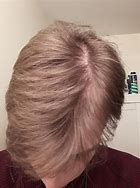 Image result for Hair Thinning Side of Head