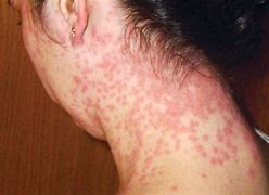 Image result for Viral Skin Rashes in Adults
