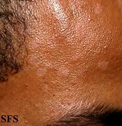 Image result for Skin Warts On Scalp