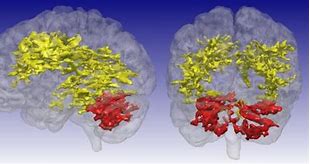 Image result for Bipolar Brain MRI