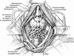 Image result for Lymph Node Dissection