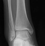 Image result for Broke My Ankle