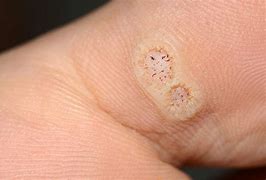 Image result for babies wart cause