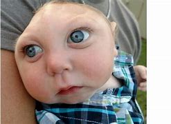 Image result for Kids Born Anencephaly