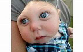 Image result for Babies Born without Brains