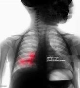 Image result for Chest X-ray Right Middle Lobe Pneumonia