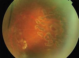 Image result for Sea Fan Retinopathy