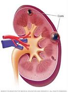 Image result for Bilateral Renal Cysts