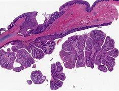 Image result for Conj Papilloma
