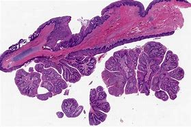 Image result for Subungual Papilloma