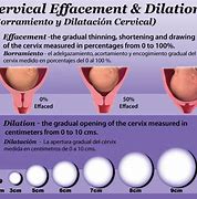 Image result for Half Cm Dilated