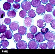 Image result for HPV Virus Skin Tags