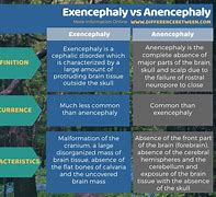 Image result for Exencephaly vs Encephalocele Radiology