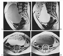 Image result for ovary dermoid cysts cancerous