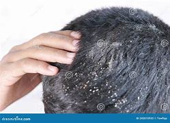 Image result for The Pictures of Male with Frustration Dandruff