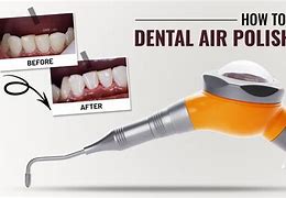 Image result for Air Polisher Dental