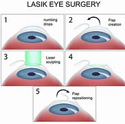 Image result for Lasik Eye Surgery for Astigmatism