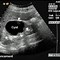 Image result for Renal Cyst Ultrasound