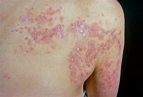 Image result for Pustular Psoriasis On Back