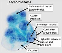 Image result for Adenocarcinoom Cirkeldiagram