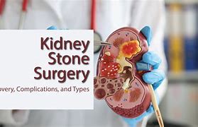 Image result for Kidney Stone Surgery Procedure