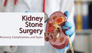 Image result for Kidney Stone Remover