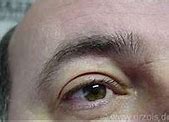 Image result for Little Wart On Eyelid