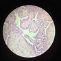Image result for Sebaceous Cyst Histology