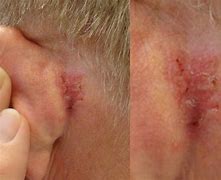 Image result for Basal Cell Skin Cancer Ear