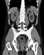 Image result for Left Lower Pole Kidney Mass