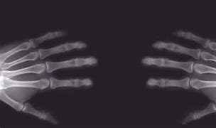 Image result for X-ray of Knuckles Cracking