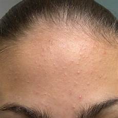 curare l acne dall interno come curare l acne lieve 4 passi curare l acne dall interno come curare l acne lieve 4 passi