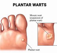 Image result for Deep Wart Removal