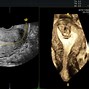 Image result for Fibroid Necrosis Ultrasound