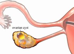 Image result for 3 Cm Ovarian Cyst
