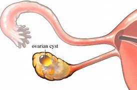 Image result for 11 Cm Cyst On Ovary