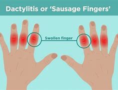 Image result for Five Finger Clinger