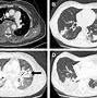 Image result for Lymphoma