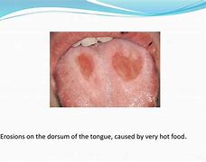 Image result for Tongue Pathology