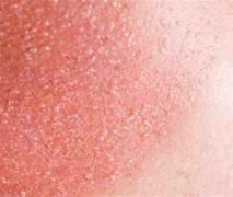 Image result for Itchy SunBurn
