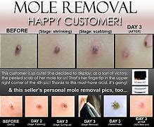 Image result for Skin Tag Wart Remover