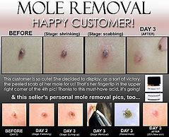 Image result for Skin Tag Wart Removal