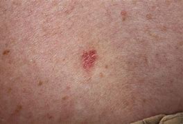 Image result for Basal Cell Carcinoma Telangiectasia
