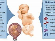 Image result for GBS Treatment Pregnancy